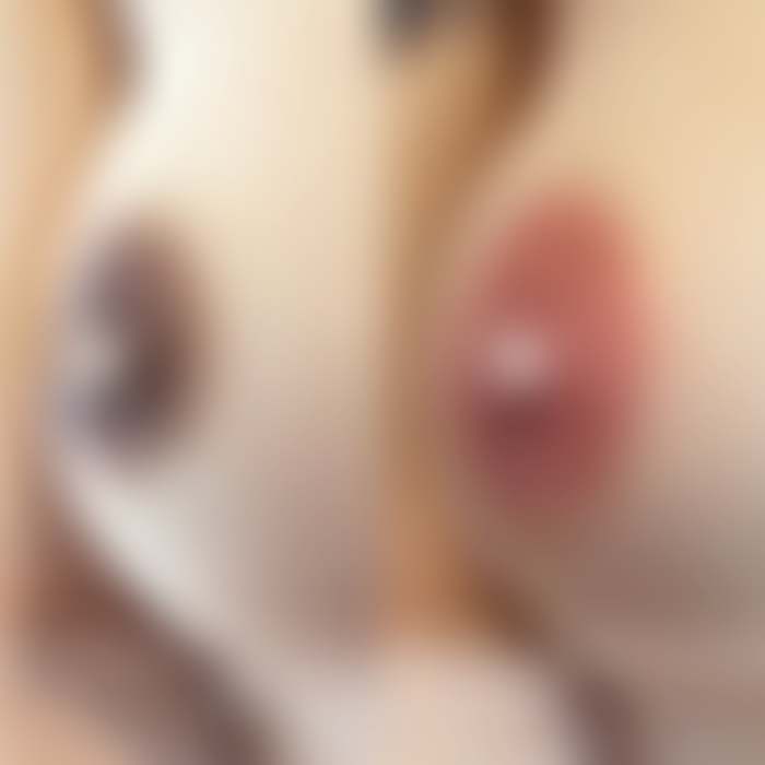 乳輪の施術例