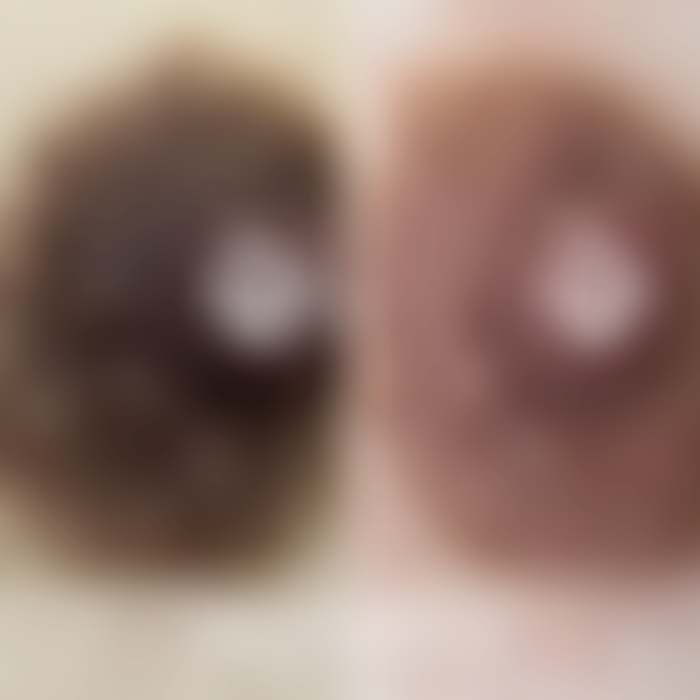 乳輪の施術例